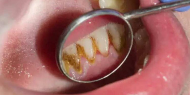 Ju formohen gurët e zi në dhëmbë? Ja si t’i largoni dhe parandaloni formimin e tyre